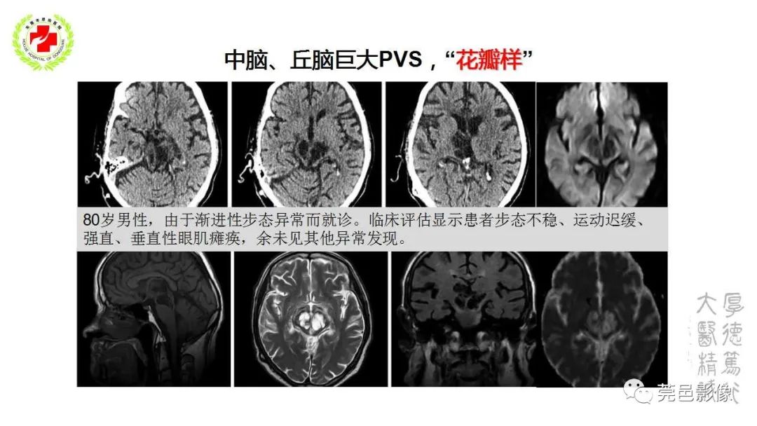 影像PPT - 【PPT】血管周围间隙及相关疾病-16