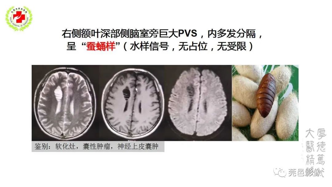 影像PPT - 【PPT】血管周围间隙及相关疾病-17