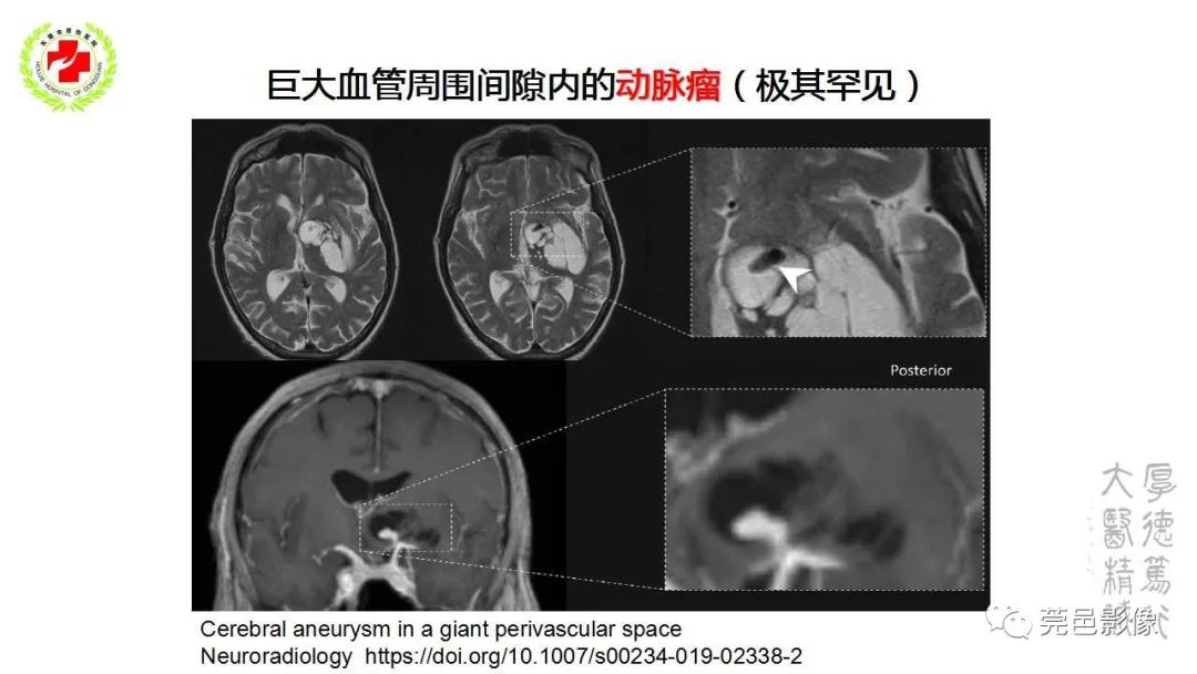 影像PPT - 【PPT】血管周围间隙及相关疾病-18