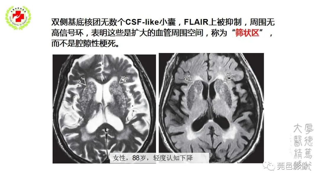 影像PPT - 【PPT】血管周围间隙及相关疾病-19