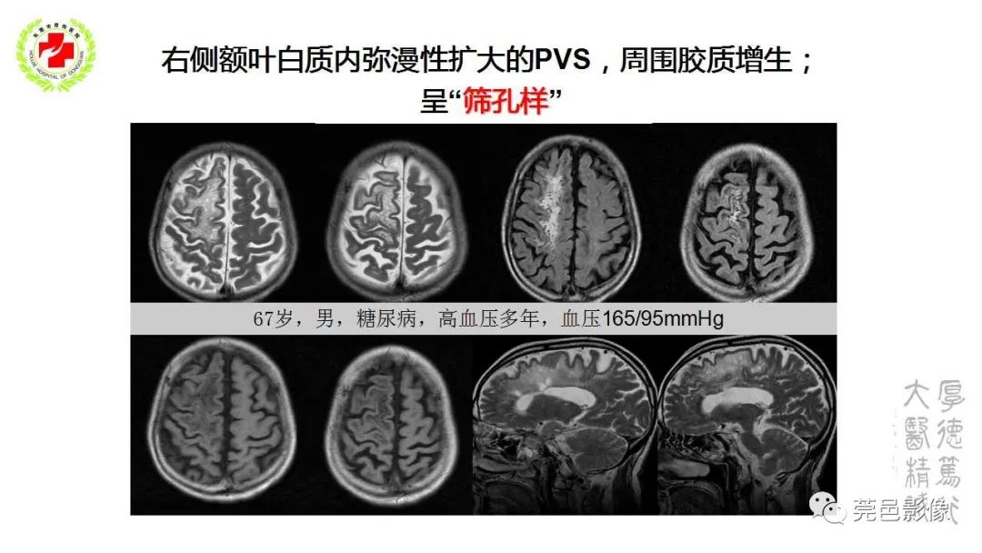 影像PPT - 【PPT】血管周围间隙及相关疾病-20