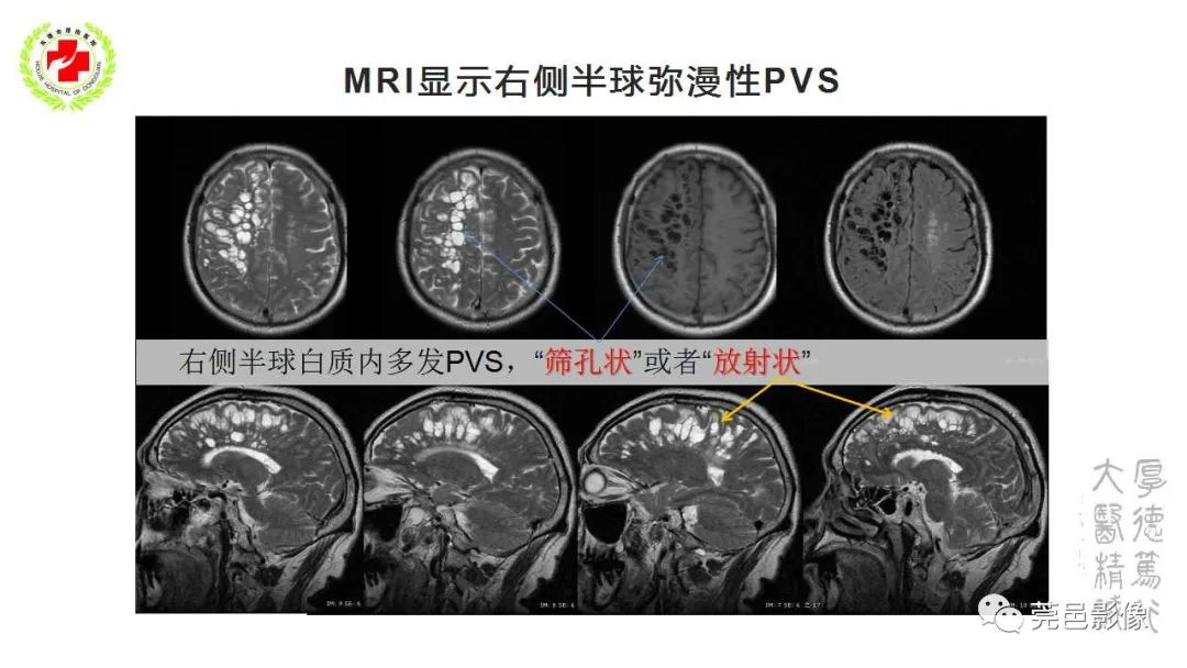 影像PPT - 【PPT】血管周围间隙及相关疾病-22
