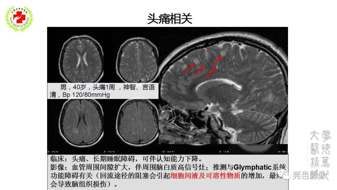 影像PPT - 【PPT】血管周围间隙及相关疾病-24
