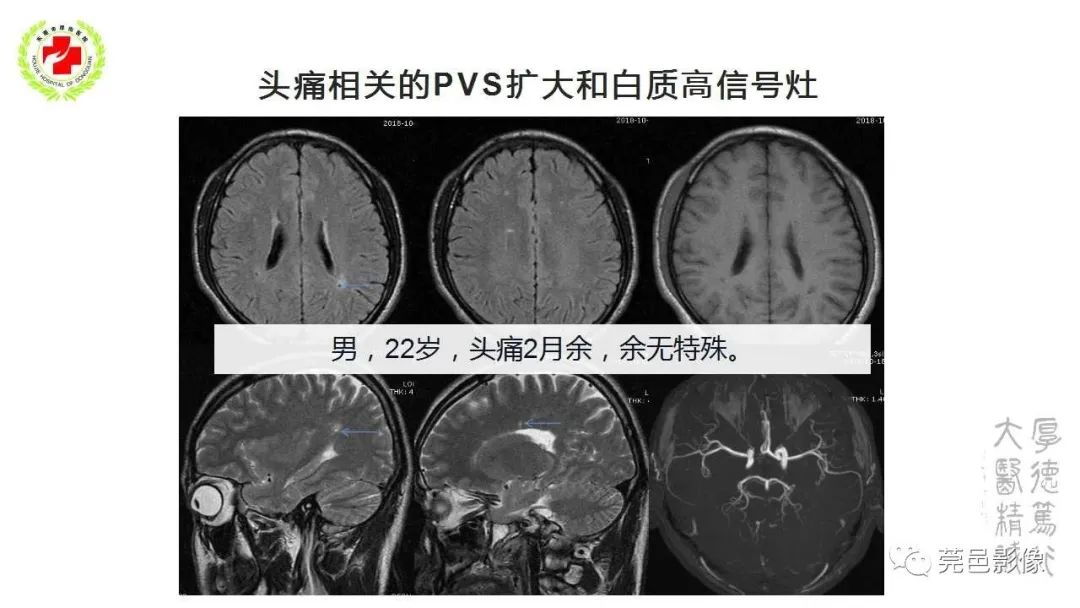 影像PPT - 【PPT】血管周围间隙及相关疾病-25