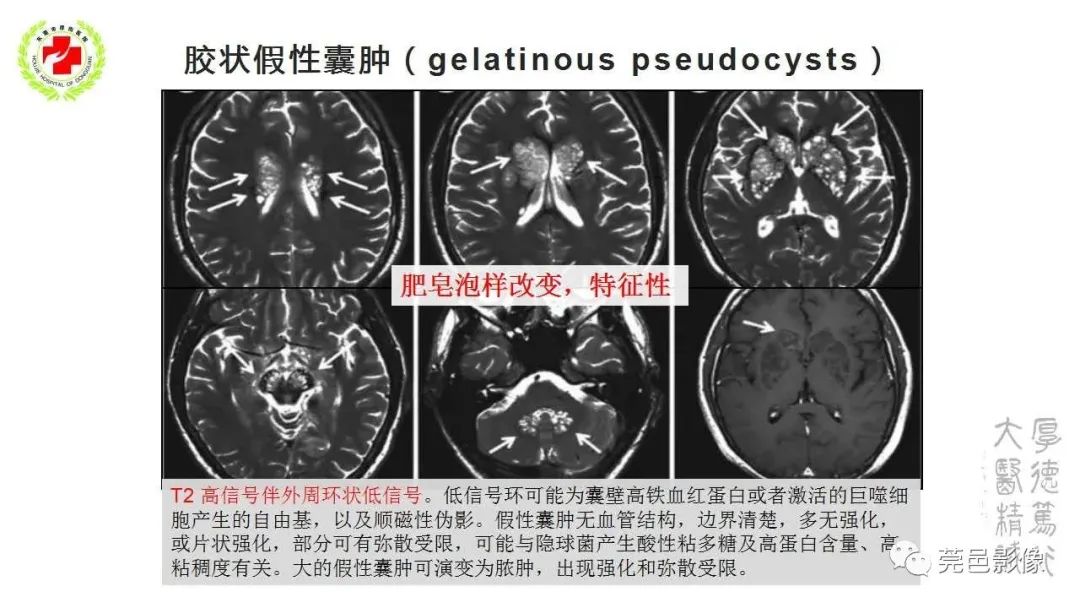 影像PPT - 【PPT】血管周围间隙及相关疾病-27