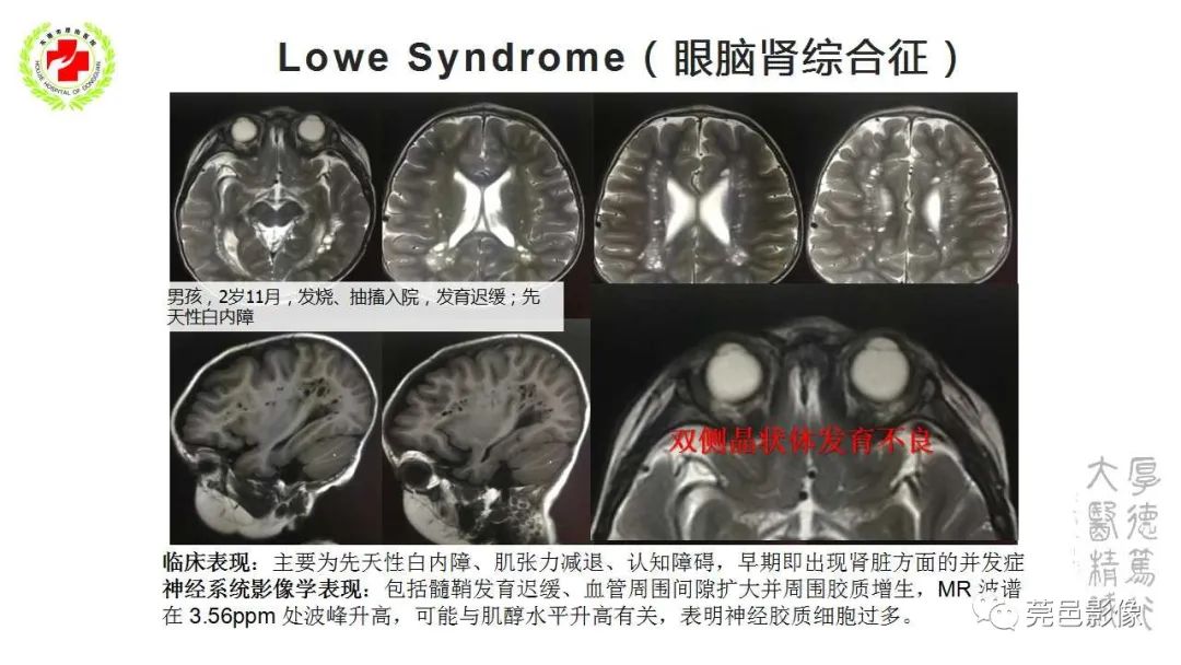 影像PPT - 【PPT】血管周围间隙及相关疾病-32