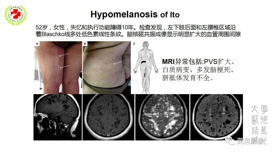 影像PPT - 【PPT】血管周围间隙及相关疾病-33