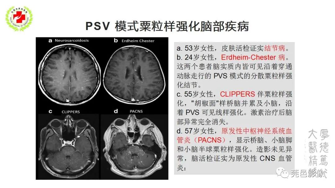 影像PPT - 【PPT】血管周围间隙及相关疾病-36