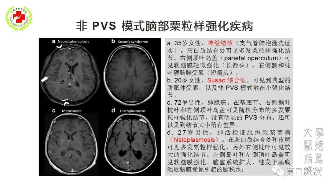 影像PPT - 【PPT】血管周围间隙及相关疾病-39