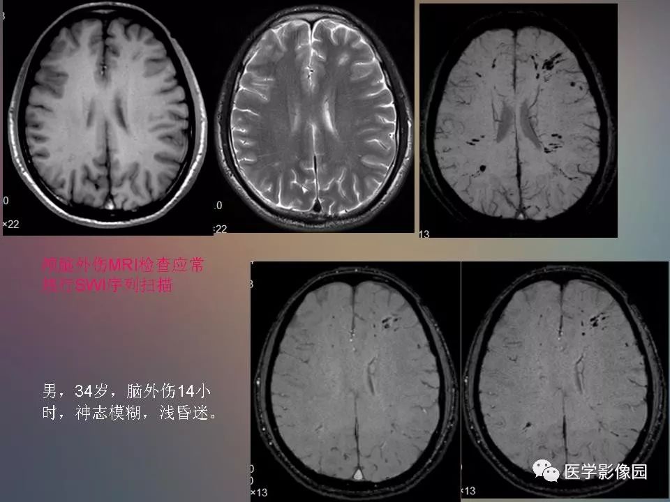 影像PPT - 【PPT】急性颅脑损伤的CT和MRI诊断-8