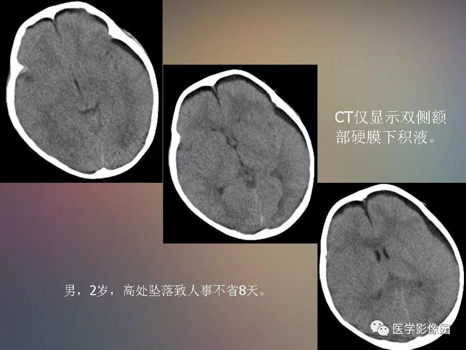 影像PPT - 【PPT】急性颅脑损伤的CT和MRI诊断-9