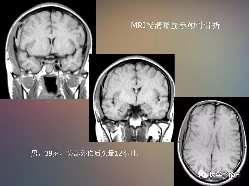 影像PPT - 【PPT】急性颅脑损伤的CT和MRI诊断-16