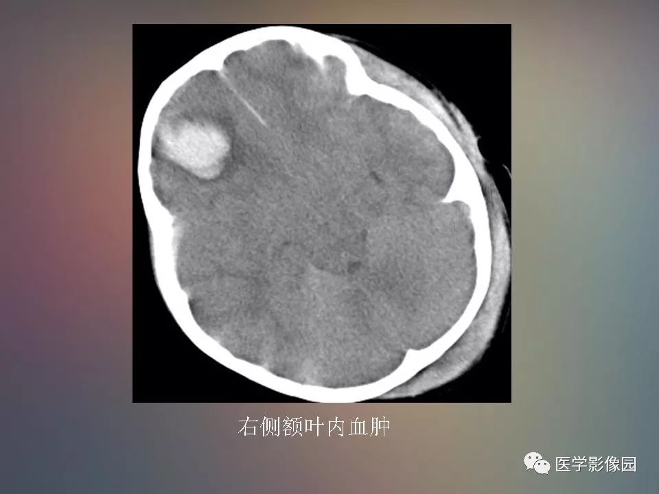 影像PPT - 【PPT】急性颅脑损伤的CT和MRI诊断-17