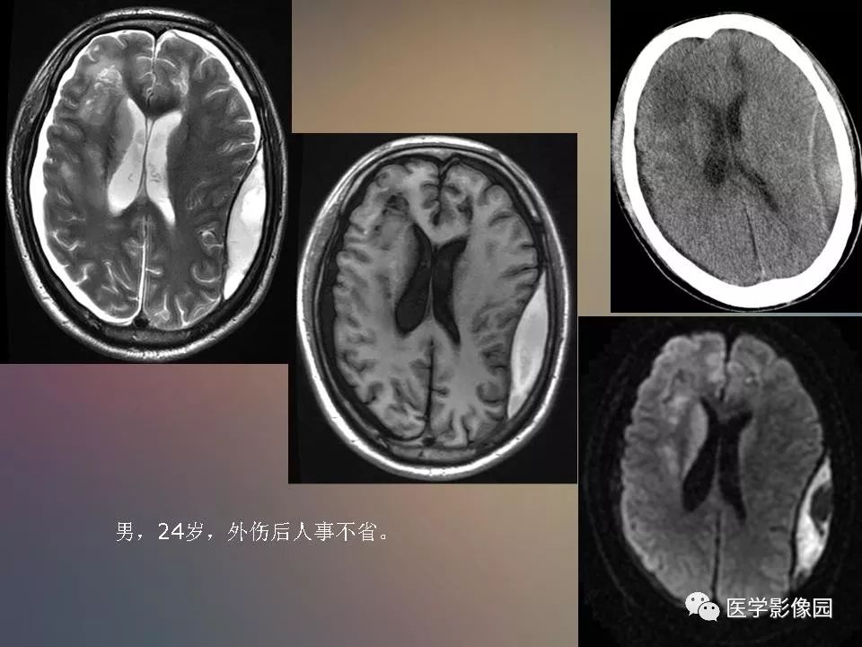 影像PPT - 【PPT】急性颅脑损伤的CT和MRI诊断-21