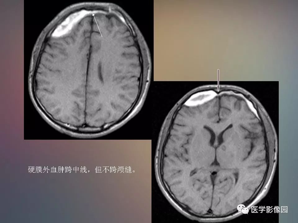 影像PPT - 【PPT】急性颅脑损伤的CT和MRI诊断-22
