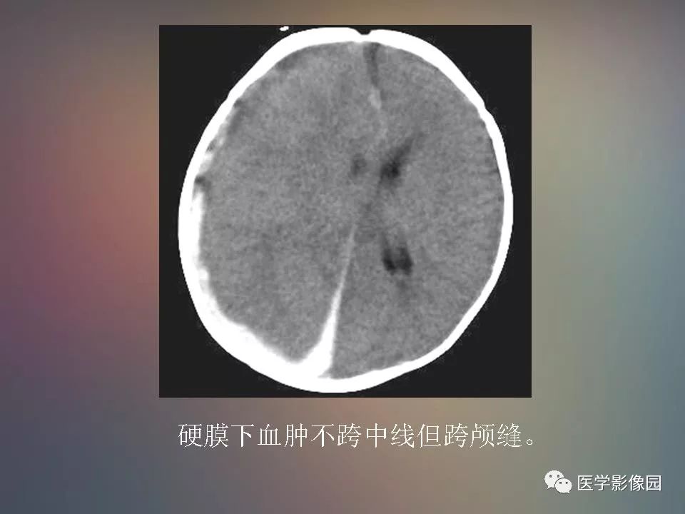 影像PPT - 【PPT】急性颅脑损伤的CT和MRI诊断-25