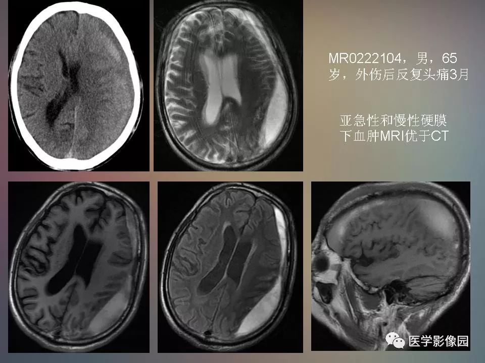 影像PPT - 【PPT】急性颅脑损伤的CT和MRI诊断-26