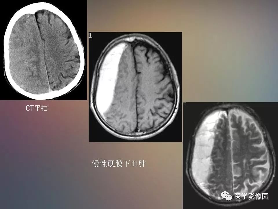 影像PPT - 【PPT】急性颅脑损伤的CT和MRI诊断-27
