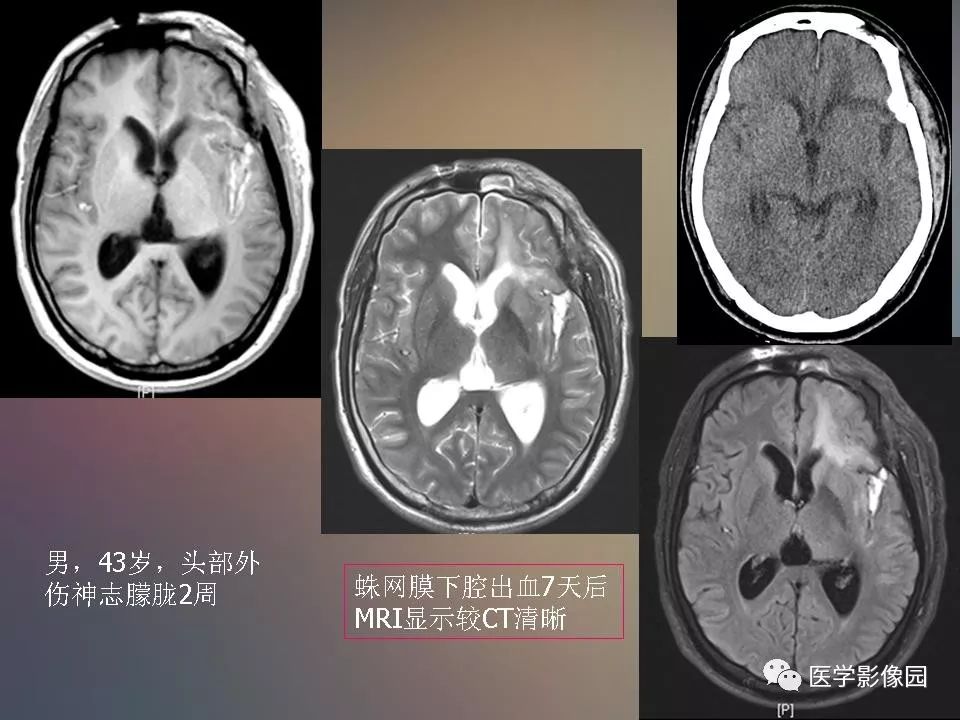 影像PPT - 【PPT】急性颅脑损伤的CT和MRI诊断-29