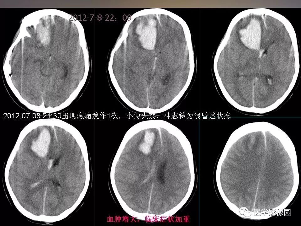 影像PPT - 【PPT】急性颅脑损伤的CT和MRI诊断-30