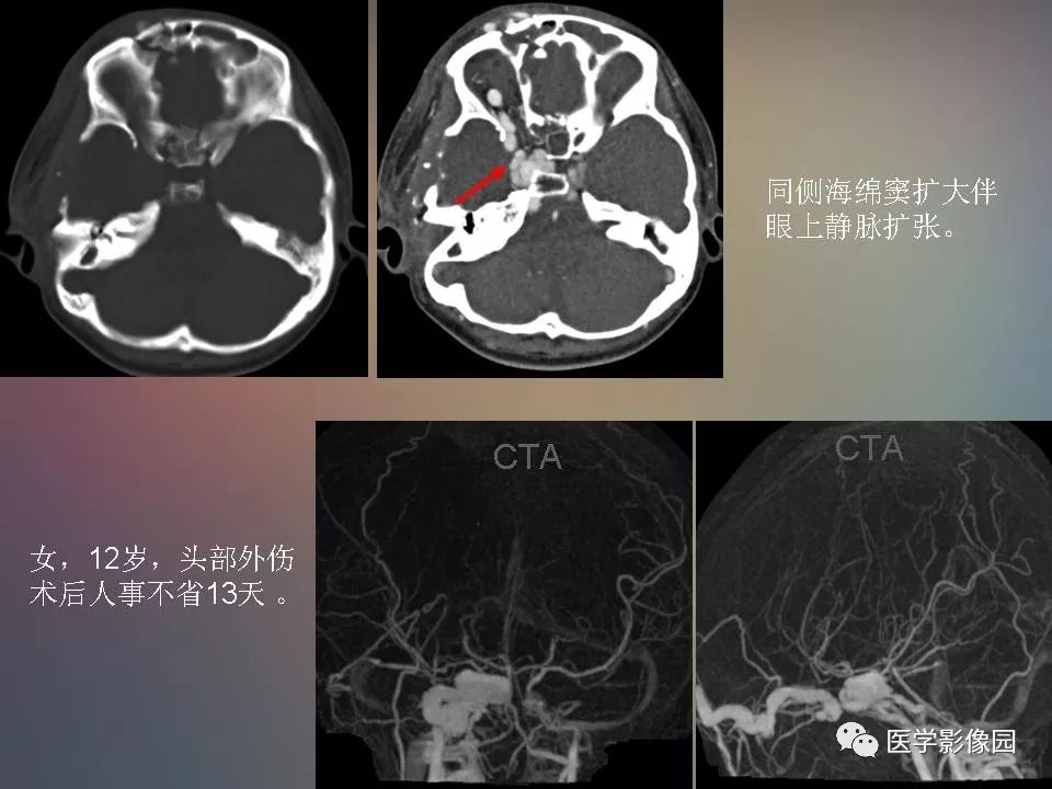 影像PPT - 【PPT】急性颅脑损伤的CT和MRI诊断-34