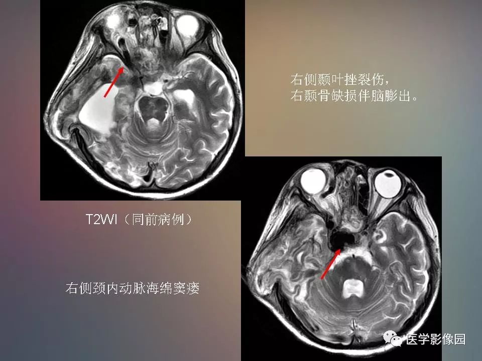 影像PPT - 【PPT】急性颅脑损伤的CT和MRI诊断-35