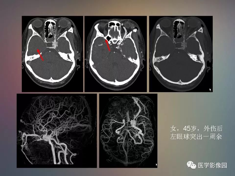 影像PPT - 【PPT】急性颅脑损伤的CT和MRI诊断-36