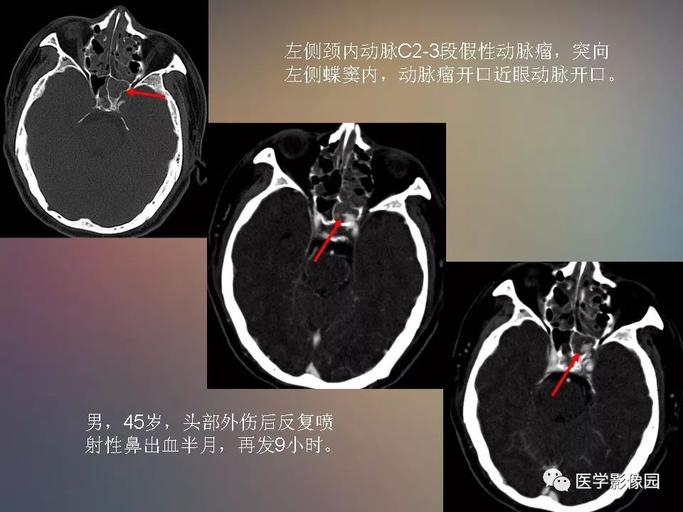 影像PPT - 【PPT】急性颅脑损伤的CT和MRI诊断-37