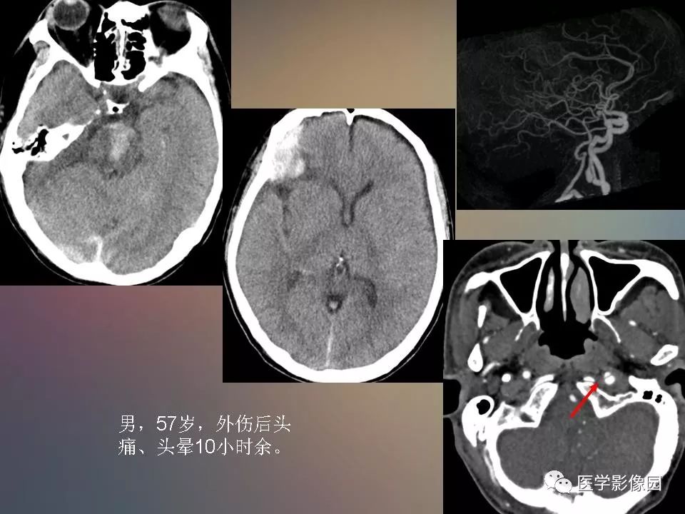 影像PPT - 【PPT】急性颅脑损伤的CT和MRI诊断-39
