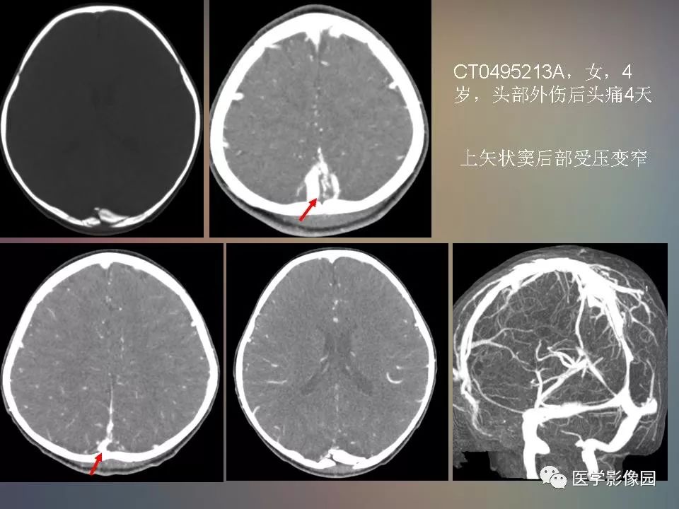 影像PPT - 【PPT】急性颅脑损伤的CT和MRI诊断-41