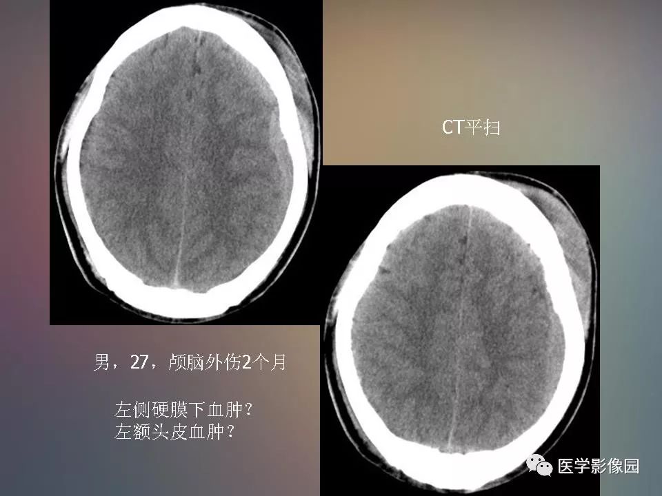 影像PPT - 【PPT】急性颅脑损伤的CT和MRI诊断-42