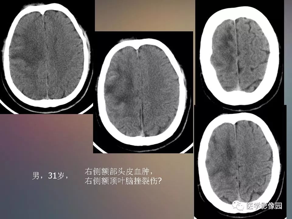 影像PPT - 【PPT】急性颅脑损伤的CT和MRI诊断-45