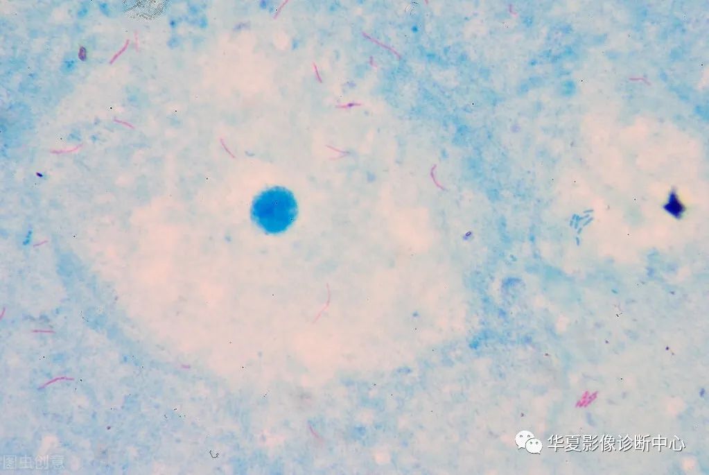 影像PPT - 掌握这4个读片小技巧,轻松鉴别肺癌与结核-1 影像PPT - 掌握这4个读片小技巧,轻松鉴别肺癌与结核-1