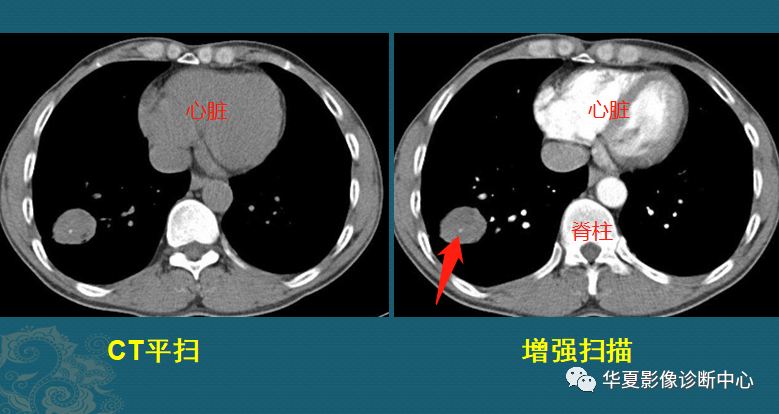 影像PPT - 掌握这4个读片小技巧,轻松鉴别肺癌与结核-3 影像PPT - 掌握这4个读片小技巧,轻松鉴别肺癌与结核-3