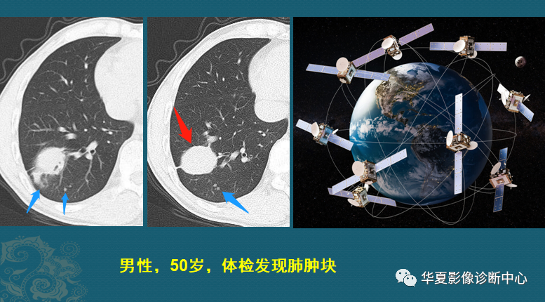 影像PPT - 掌握这4个读片小技巧,轻松鉴别肺癌与结核-2 影像PPT - 掌握这4个读片小技巧,轻松鉴别肺癌与结核-2
