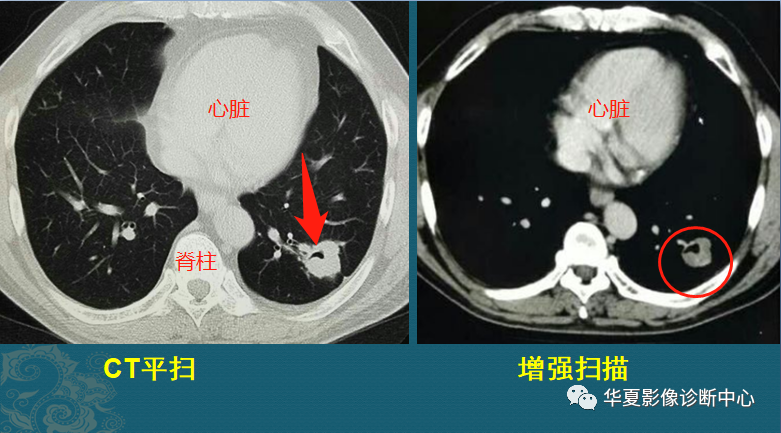 影像PPT - 掌握这4个读片小技巧,轻松鉴别肺癌与结核-4 影像PPT - 掌握这4个读片小技巧,轻松鉴别肺癌与结核-4