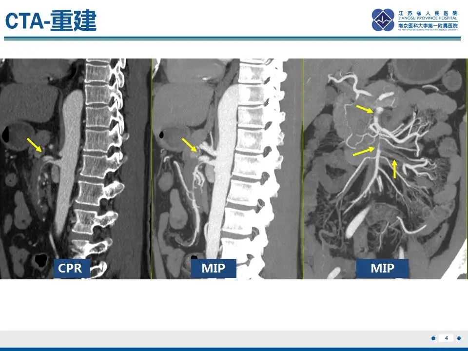 影像PPT - 【PPT】自发性孤立性肠系膜上动脉夹层-5
