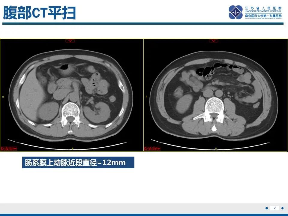 影像PPT - 【PPT】自发性孤立性肠系膜上动脉夹层-3