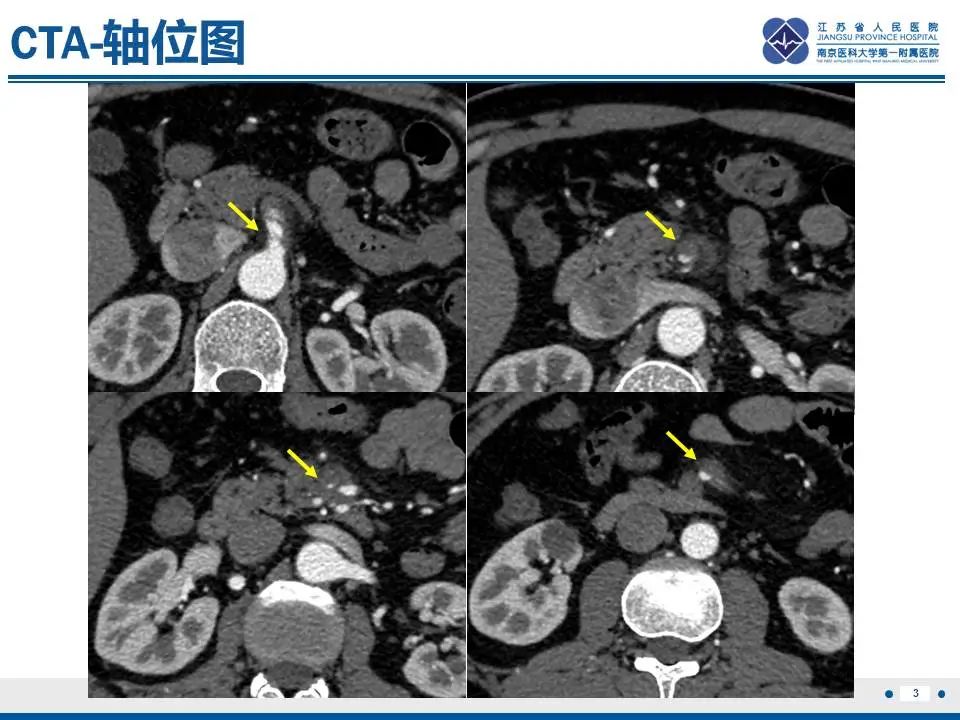 影像PPT - 【PPT】自发性孤立性肠系膜上动脉夹层-4