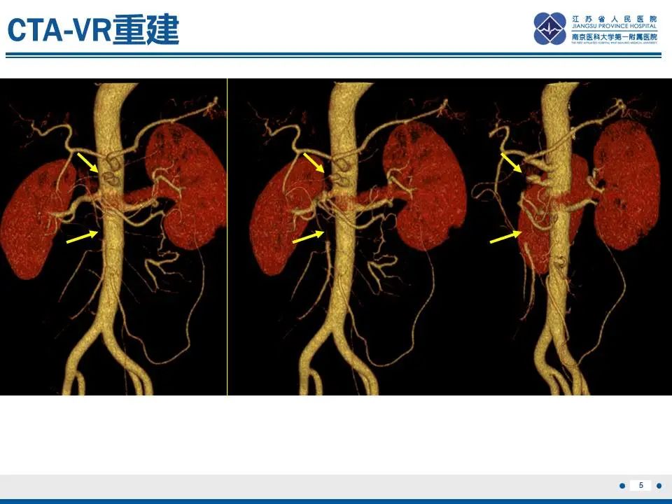 影像PPT - 【PPT】自发性孤立性肠系膜上动脉夹层-6