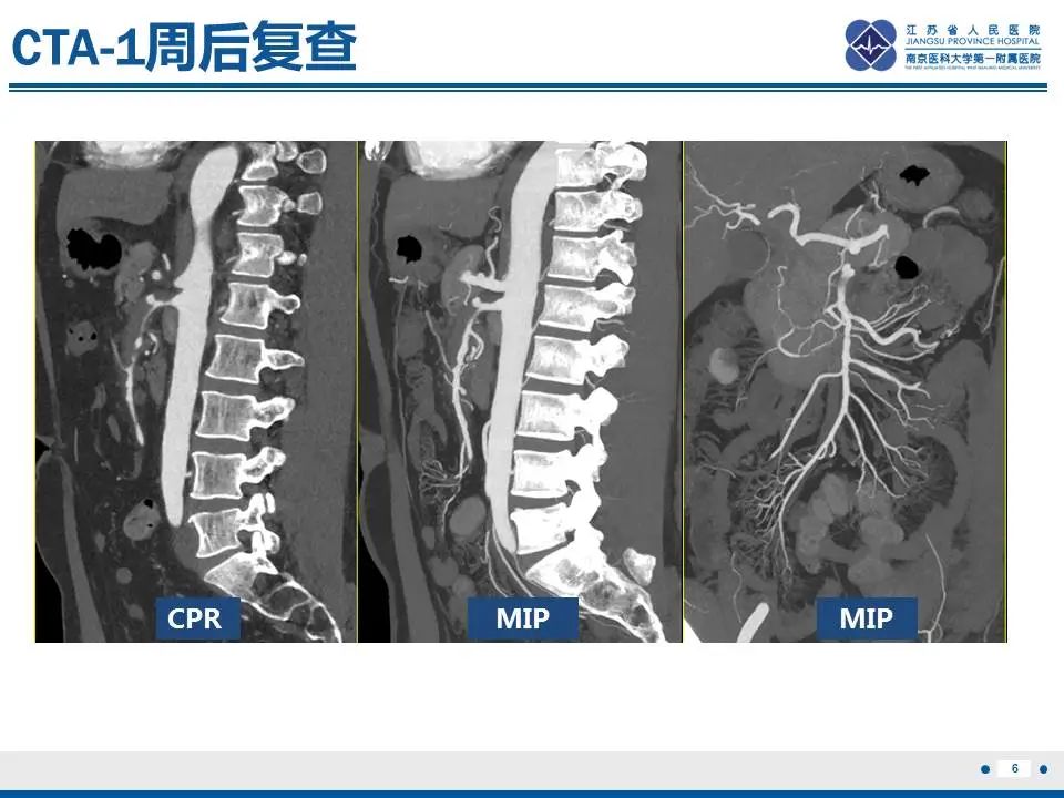 影像PPT - 【PPT】自发性孤立性肠系膜上动脉夹层-7