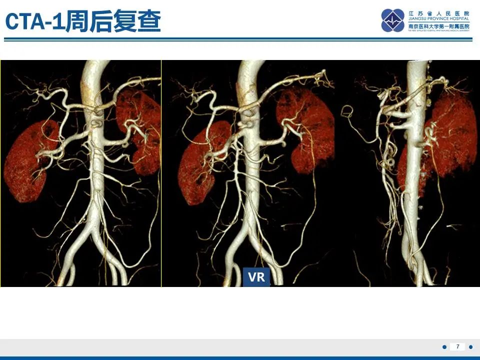 影像PPT - 【PPT】自发性孤立性肠系膜上动脉夹层-8