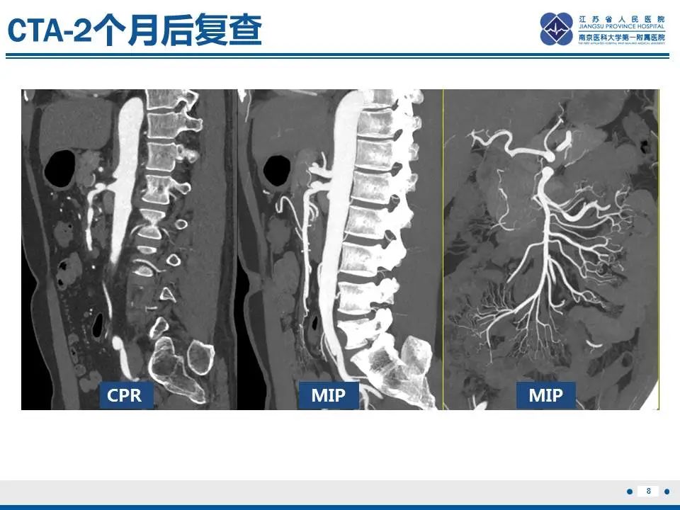 影像PPT - 【PPT】自发性孤立性肠系膜上动脉夹层-9