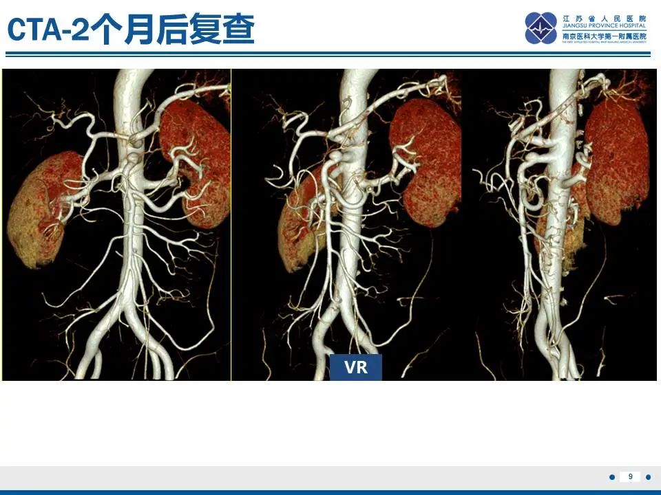 影像PPT - 【PPT】自发性孤立性肠系膜上动脉夹层-10