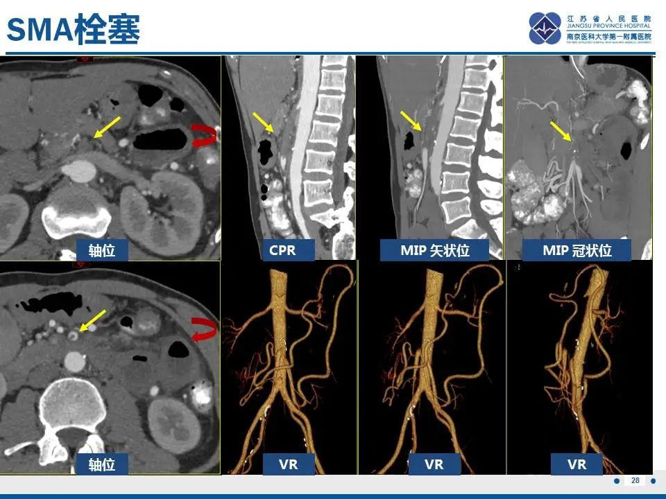 影像PPT - 【PPT】自发性孤立性肠系膜上动脉夹层-29
