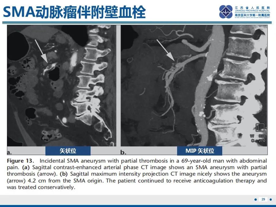 影像PPT - 【PPT】自发性孤立性肠系膜上动脉夹层-30