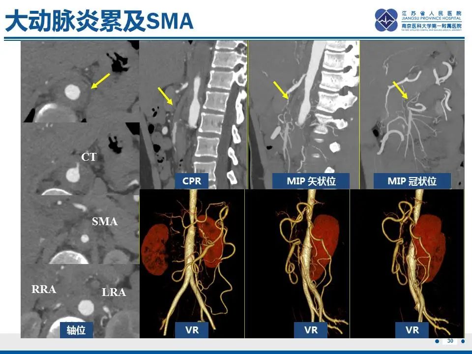 影像PPT - 【PPT】自发性孤立性肠系膜上动脉夹层-31
