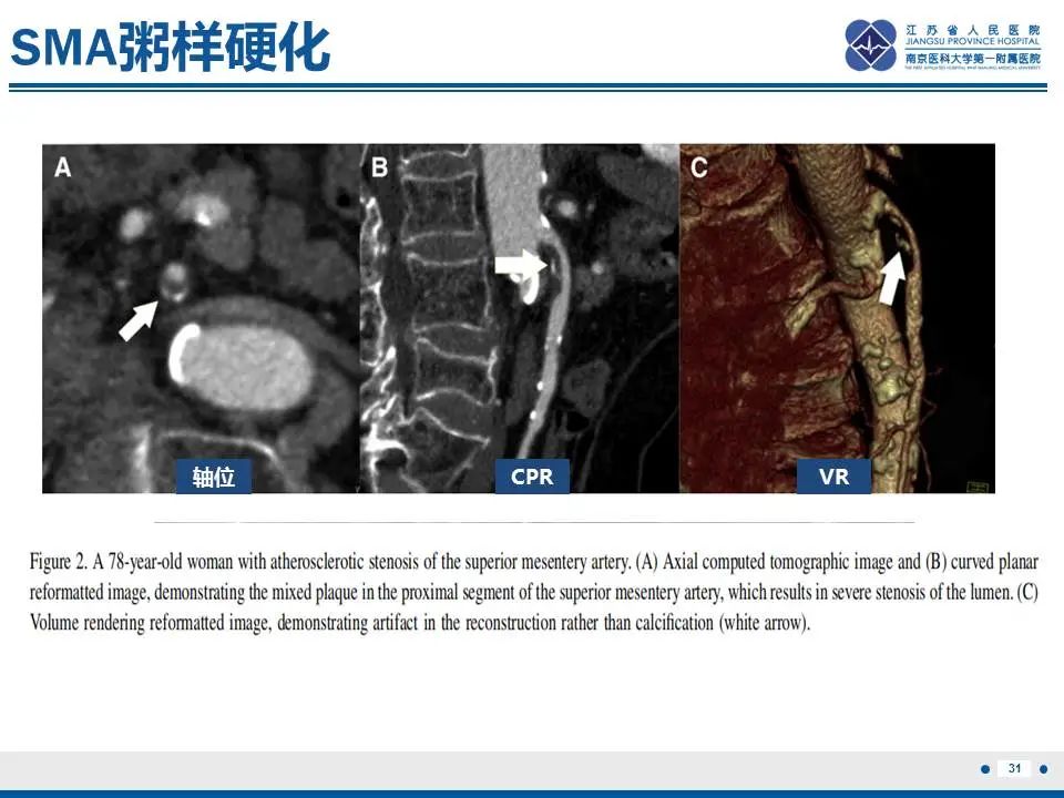 影像PPT - 【PPT】自发性孤立性肠系膜上动脉夹层-32