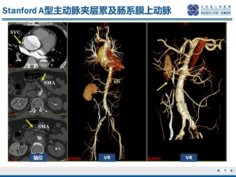 影像PPT - 【PPT】自发性孤立性肠系膜上动脉夹层-33