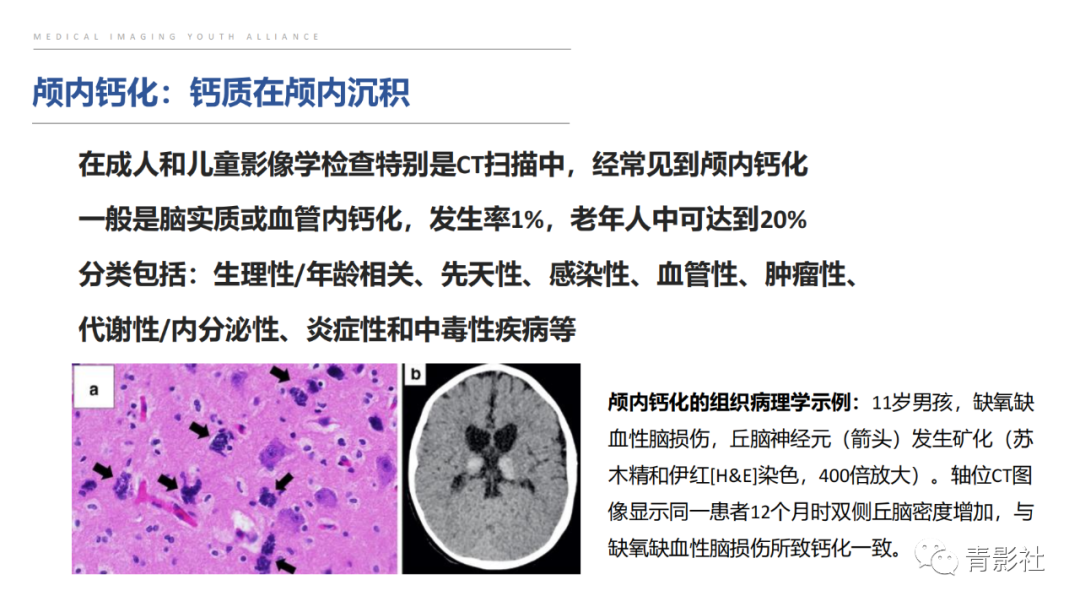 影像PPT - 【PPT】颅内钙化病变的影像诊断思路-4